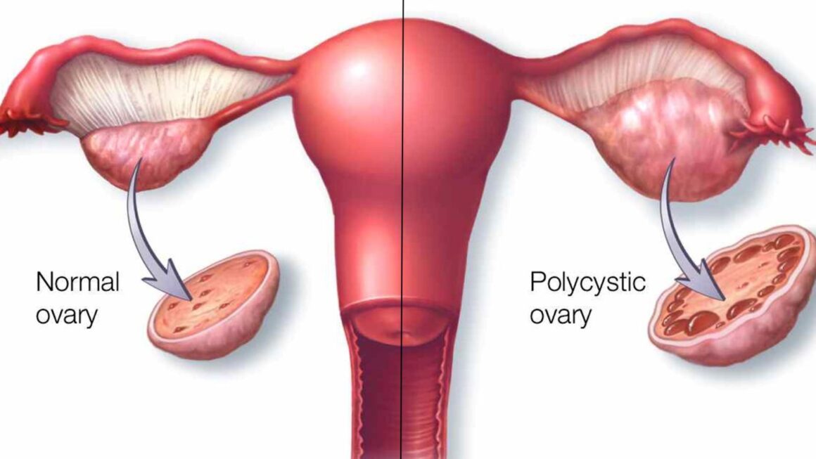The Modern PCOS